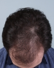 Before Hair Transplant&nbsp;Front